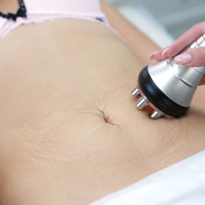 Curso de camuflagem de estrias online